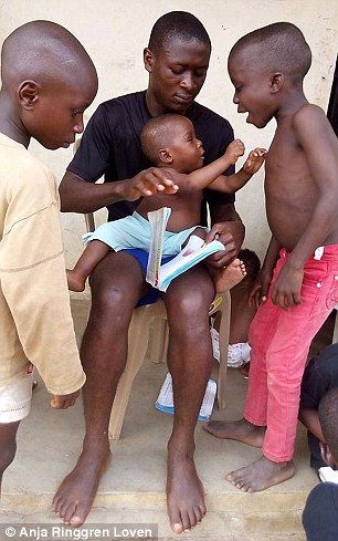 Incredible recovery of the Nigerian 'witch child' who was left for dead by his parents 2
